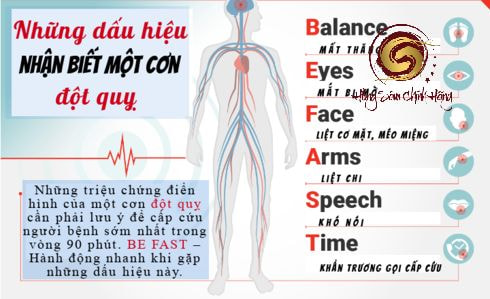 Những dấu hiệu báo trước dễ nhận biết của người bị đột quỵ