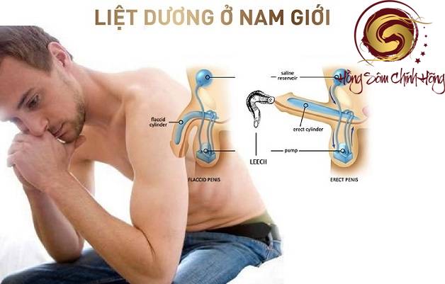 liệt dương có chữa được không