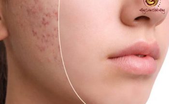hảo sâm trị mụn